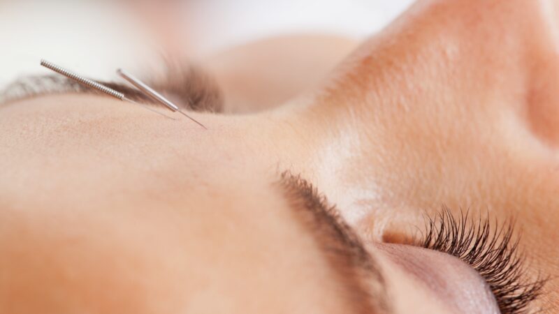 igłoterapia estetyczna, ent, akupunktura estetyczna, needles therapy,